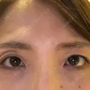 二重切開 / 眼瞼下垂（切開） / 上まぶたたるみ取り 湘南美容クリニック 高田馬場院 BEFORE サムネイル用