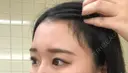 ヒアルロン酸注入（額） 東京イセアクリニック BEFORE サムネイル用