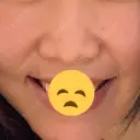 肌ヒアルロン酸注入（たるみ・シワ改善） 水の森美容クリニック 大阪梅田院 BEFORE サムネイル用