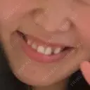 ガミースマイル手術 / 口角挙上 / ボトックス（口角） / その他（口元） 水の森美容クリニック 大阪梅田院 BEFORE サムネイル用