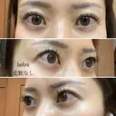 糸リフト / クマ治療 / 額を丸く / その他（輪郭） / こめかみ形成 / 脂肪注入（額） / 脂肪注入（輪郭） / その他（口元） 湘南美容クリニック 品川院 BEFORE サムネイル用
