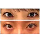 二重埋没 表参道スキンクリニック 表参道院 BEFORE サムネイル用