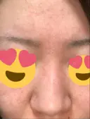 スレッドノーズ あらなみクリニック 静岡院 BEFORE サムネイル用