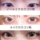 二重埋没 共立美容外科 大宮院 BEFORE サムネイル用