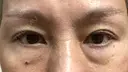 下まぶたたるみ取り / 下まぶたの脂肪取り ヨーダー公子クリニック眼科・美容皮膚科 横浜六浦院 BEFORE サムネイル用