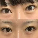 蒙古ひだ形成 R.O.clinic BEFORE サムネイル用