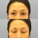目尻切開 湘南美容クリニック 秋葉原院 BEFORE サムネイル用