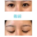 上まぶたの脂肪取り / 眉下切開 JUN CLINIC BEFORE サムネイル用