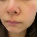 ほくろ・いぼ切除（肌） / ほくろ・いぼ除去レーザー（肌） 赤坂メディカルMクリニック BEFORE サムネイル用