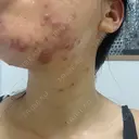 ニキビ治療 アサイクリニック 心斎橋本院 BEFORE サムネイル用