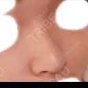 隆鼻術 / 鼻尖形成（切開） / 鼻中隔延長（切開） / 鼻尖縮小 FROM B整形外科 (旧バウム整形外科) BEFORE サムネイル用