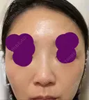 ヒアルロン酸注入（鼻） 新宿ビューティークリニック 新宿院 BEFORE サムネイル用