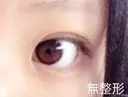 目頭切開 / 目尻切開 FROM B整形外科 (旧バウム整形外科) BEFORE サムネイル用