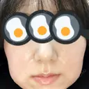 脂肪溶解注射（顔） 赤坂プレミアクリニック BEFORE サムネイル用