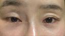 二重切開 / 眼瞼下垂（切開） / クマ治療 / 上まぶたたるみ取り / 眉下切開 くさのたろうクリニック BEFORE サムネイル用