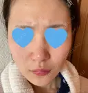 フォトRF 湘南美容クリニック 柏院 BEFORE サムネイル用