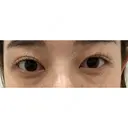 クマ治療 / 下まぶたの脂肪取り ルラ美容クリニック 高田馬場院 BEFORE サムネイル用
