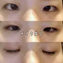 目頭切開 / 眼瞼下垂（切開） 白山クリニック 大分 BEFORE サムネイル用