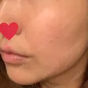 シミ取りレーザー / ピコレーザートーニング（美白・肝斑） UB CLINIC銀座 BEFORE サムネイル用