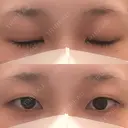 二重埋没 湘南美容クリニック 金沢院 BEFORE サムネイル用