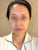 脂肪吸引（顔） / 切開リフト / 脂肪注入（輪郭） 牧野美容クリニック BEFORE サムネイル用