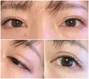 二重切開 北尾クリニック BEFORE サムネイル用