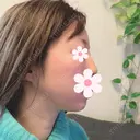 脂肪吸引（顔） 北尾クリニック BEFORE サムネイル用