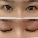 二重埋没 / 二重切開 宇都宮竹内クリニック BEFORE サムネイル用