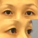 眼瞼下垂（切開） 湘南美容クリニック 秋葉原院 BEFORE サムネイル用