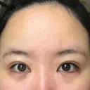 目尻切開 / タレ目形成・グラマラスライン（切開） B-LINE CLINIC 池袋院 BEFORE サムネイル用