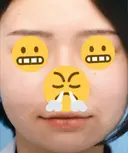 ほくろ・いぼ切除（肌） / ほくろ・いぼ除去レーザー（肌） 赤坂メディカルMクリニック BEFORE サムネイル用