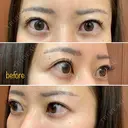 二重埋没 湘南美容クリニック 品川院 BEFORE サムネイル用