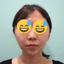 糸リフト / 脂肪吸引（顔） / ボトックス（あご） WOM CLINIC GINZA （ワム クリニック ギンザ） BEFORE サムネイル用