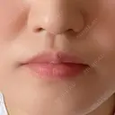 ヒアルロン酸注入（唇） / ボトックス（口角） アネシス美容クリニック BEFORE サムネイル用