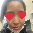 ダーマペン 表参道スキンクリニック 名古屋院（DAILY SKIN CLINIC提携院） BEFORE サムネイル用