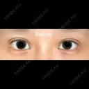 目尻切開 / 目尻靭帯移動 VARABON美容外科 BEFORE サムネイル用