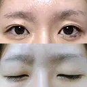 二重切開 松下皮フ形成外科 BEFORE サムネイル用