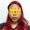 骨切り（あご） / 骨削り（頬） / ルフォー+ssro（両あご) リラ・クラニオフェイシャル・クリニック BEFORE サムネイル用