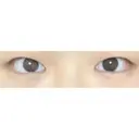 二重切開 / 目頭切開 東京イセアクリニック BEFORE サムネイル用