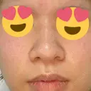 隆鼻術 / 鼻尖形成（切開） / 鼻中隔延長（切開） / 骨切幅寄せ 表参道スキンクリニック 表参道院 BEFORE サムネイル用