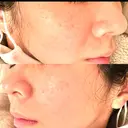 シミ取りレーザー 仁愛クリニック BEFORE サムネイル用