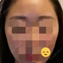 額を丸く / 脂肪注入（肌） / 脂肪注入（額） ヴェルトラクリニック 大阪院 BEFORE サムネイル用