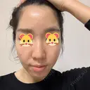 ピーリング（ニキビ・毛穴） / ダーマペン TRUE DESIGN CLINIC BEFORE サムネイル用