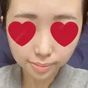 ヒアルロン酸注入（鼻） / ヒアルロン酸注入（あご） 新宿ビューティークリニック 新宿院 BEFORE サムネイル用