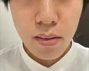 イオン導入 / 毛穴洗浄（ハイドラフェイシャルなど） Zetith Beauty Clinic 銀座院 BEFORE サムネイル用