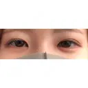 ヒアルロン酸注入（涙袋） / ヒアルロン酸注入（鼻） 柳津あおやま眼科クリニック BEFORE サムネイル用