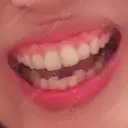 ガミースマイル手術 有楽町美容外科クリニック BEFORE サムネイル用
