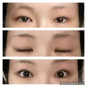 二重切開 / 目頭切開 / 眼瞼下垂（切開） / 上まぶたの脂肪取り 銀座マイアミ美容外科 BEFORE サムネイル用
