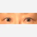 二重切開 / 上まぶたたるみ取り 表参道スキンクリニック 表参道院 BEFORE サムネイル用