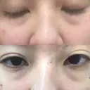 クマ治療 / 下まぶたたるみ取り セオリークリニック BEFORE サムネイル用